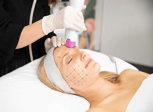 Thermage FLX radiofrequency treatment being performed on the face